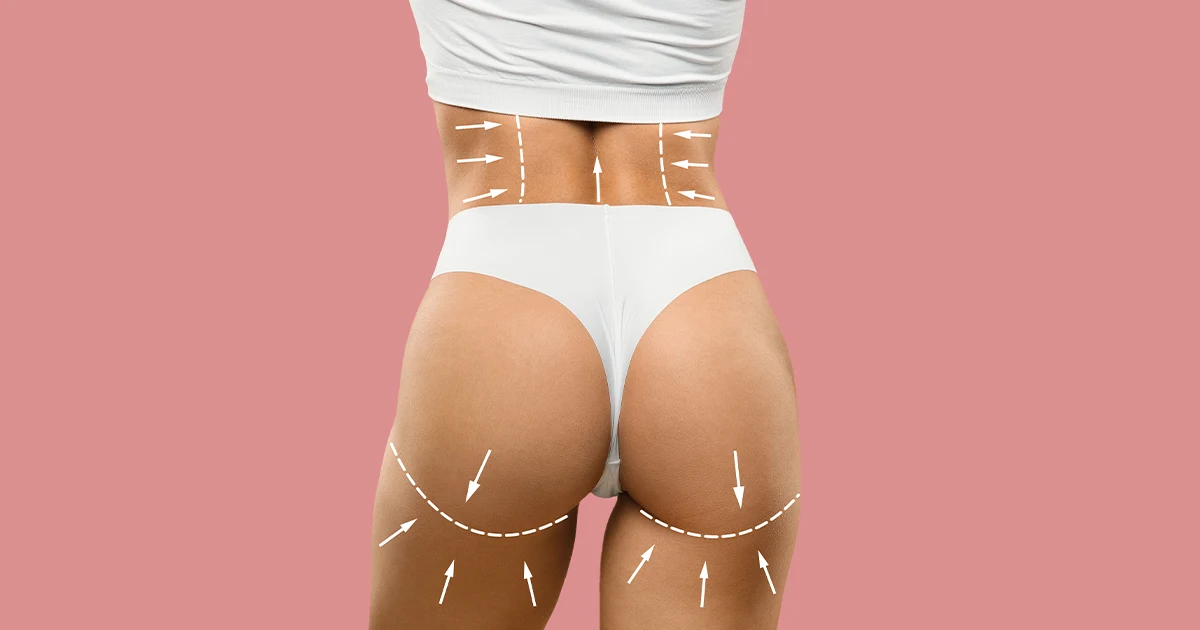 Lipotrasferencia Glutea